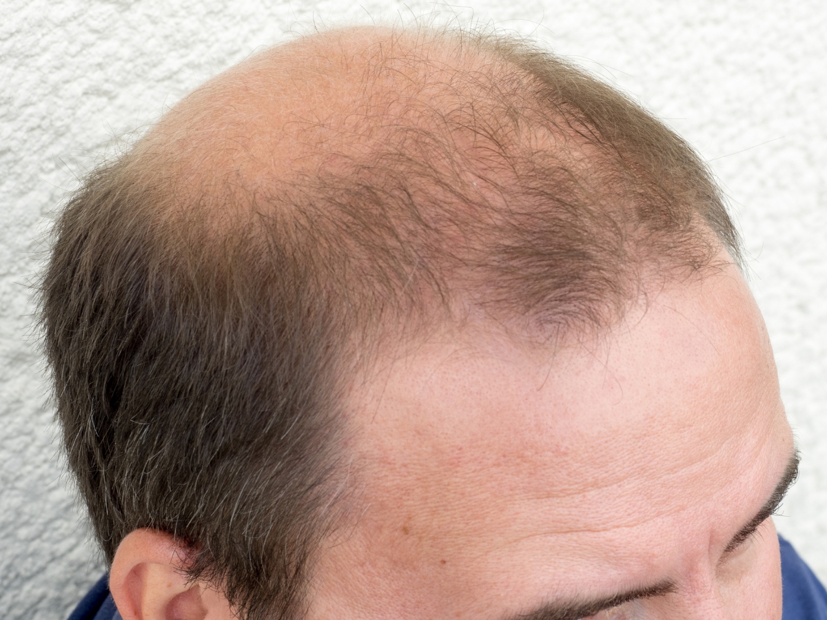 Read more about the article Understanding the Roots: Common Causes of Hair Loss in Men