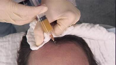 Exploring the Effectiveness of PRP Hair Loss Treatment