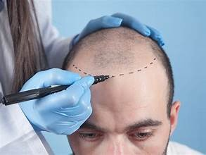 The Definitive Guide to Modern Hair Transplant Treatments