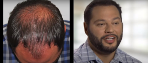 How Hair Transplants Can Restore Your Confidence
