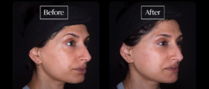 The Comprehensive Guide to Dermal Fillers for Facial Rejuvenation