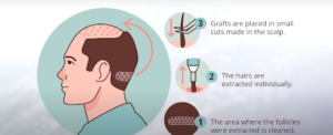 Roots of Renewal: Exploring the Latest Advancements in Hair Transplant Surgery