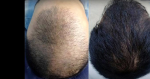 Roots of Renewal: Exploring the Latest Advancements in Hair Transplant Surgery