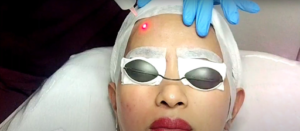 Sculpting Radiance: The Art and Science of Dermal Fillers in 2024
