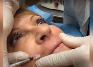Sculpting Radiance: The Art and Science of Dermal Fillers in 2024