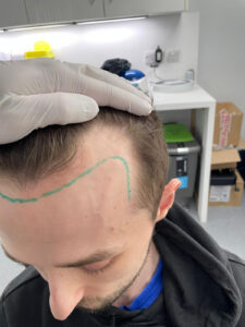After psoriasis treatment showing improved scalp condition and reduced inflammation at East Park Healthcare Blackburn