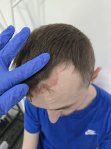 Before psoriasis treatment showing scalp inflammation and flaking in Blackburn patient