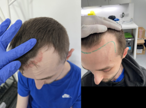 Scalp psoriasis treatment results at East Park Healthcare Blackburn
